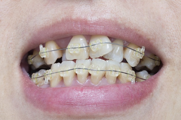 Close-up mouth of crooked teeth with braces