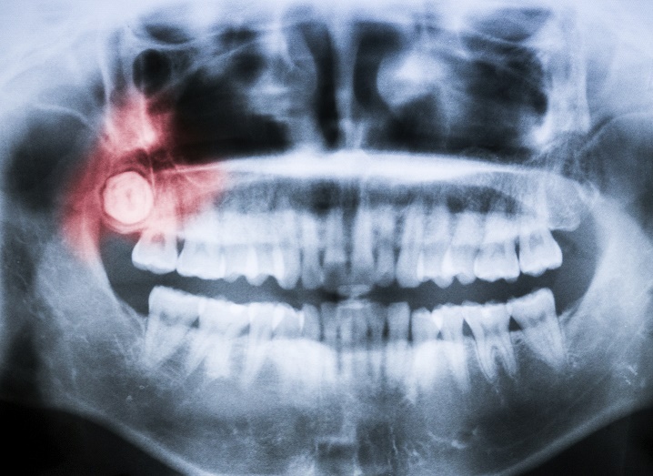 Closeup x-ray of impacted wisdom tooth