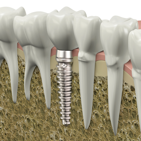 Dental implant