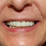 Close-up of person's smiling face showing teeth and mouth against neutral background.