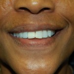Close-up of person's smiling face showing teeth and mouth area