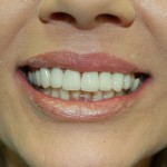 Close-up of a person's smile showing white teeth and natural lip color indoors