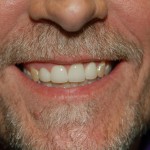 Close-up of middle-aged man's smiling face showing teeth and facial hair