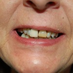 Close-up of person's smile showing teeth and lips against skin.