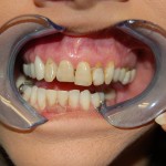 Person displaying teeth with cheek retractors during dental examination or consultation.