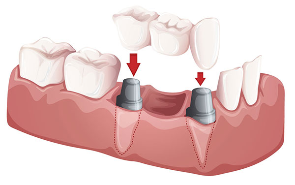 Dental Bridges Jacksonville, AR