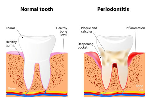 Gum Disease Jacksonville, AR