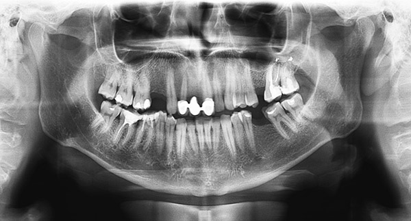 General-Dentistry-Orthodontics-Cooper-Family-Dentistry-Jacksonville, AR-Servicespage-Routine-Dental-Care-Digital-X-ray Panoramic dental X-ray showing full mouth teeth structure and jaw alignment.
