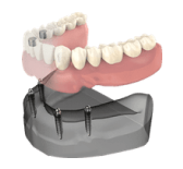 Dental implant model showing teeth replacement procedure with prosthetic teeth and jaw structure.