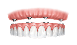 Dental implant-supported denture showing artificial teeth attachment to implant posts in gum tissue.