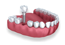 Dental implant model showing tooth replacement procedure on artificial gum structure with screw.
